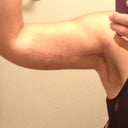 6 weeks post op, L arm