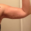 6 weeks post op, R arm