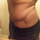 4 month scar - right side