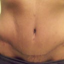 4 month scar - front