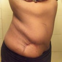4 month scar - left side
