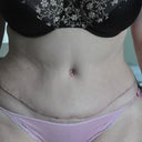 Six weeks post op. Scar healing nicely. Still feel tight at the end of the day but swelling way down.