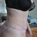 Six weeks post op.