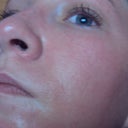 Five weeks post laser