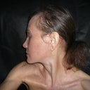 3 months post-op, no makeup, age 53