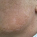 2 Years After Laser Skin Resurfacing