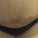Close up at 6 weeks of my blistering above incision. It is almost healed!!