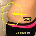 Results from not wearing a binder at all. Yikes!!!