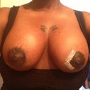 Post op day 9 and feeling great