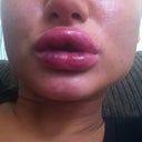 6 hrs later...hopefully worse before better
