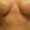 450cc saline over muscle done in 2002, severe rippling