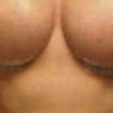July 2011, 6 days post op, 700cc saline implants overfilled to 800 cc over muscle