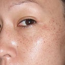This is less than 24hrs after the treatment. I have really dark freckles. My hyper pigmentation on forehead may take a while to reduce.