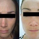 Skipped the rest of the days as my skin just started peeling until day 7 and it was pretty tough to be outside. This is three weeks post.  Can't actually say I look any better and perhaps the pigmentation is worse....