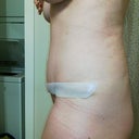 POD 22. Am I still swollen? Wearing silicone sheeting.