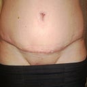 POD 22. Front side. Scar over pubic area is looking slightly better with silicone application