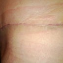 POD 22. Hip areas are both healing nicely, even though the ends of the incision are the most painful.