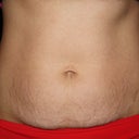 Before surgery