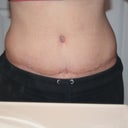 scar 6 wks