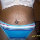 9 days postop I still have alot of stretch marks but extra skin is gone! I cant wait for the swelling to go down