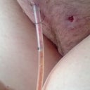 POD 14: A drain out! Hurt like heck to come out but now it is and it feels goooood. Really red though.