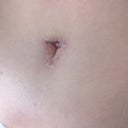 POD 14: My belly button glue has come off. There are still sutures at the top, I think when the swellings goes down it will start to sink in a bit.
