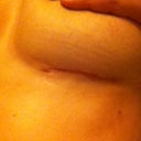 Left scar 4 weeks