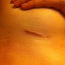 Right scar 4 weeks