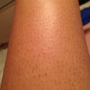 Post 3rd treatment- At maybe 90% reduction! Haven't shaved in 5 days!!! Yay! (Pardon the keratosis pilaris)