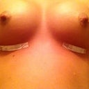 Incisions! So small!! :)