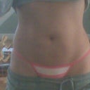 3 months post op 