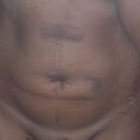 day 5 post op (ouch!) 