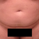 Front View - day of surgery. The doctor also took some fat from my pubic area.