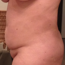 Side View - day of surgery.