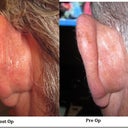 Fiances Ostoplasty before and after pics. Left ear. NO CHANGE! no cartlidge removed at all!