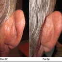 Fiances ostoplasty before and after pics. Right ear, skin pulled over 1-2cm, No cartlidge removed at all!