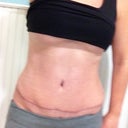 Scar at 12 weeks, photo is deceiving, it is low and straight, not visible in any of my bikini panties!