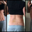 Day 3: Post-Op Flank (Slight yellow bruising/still swollen)