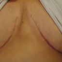 16 weeks po a better view of how well my scar gel worked.  I'm now using it on my entire BA scar