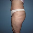 I am hoping that the areas on my thighs where I had the lipo will continue to smooth out.