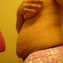 4 weeks after lipo