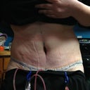 1 day post op front side standing up.