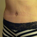 18 days PO; the lines are due to the binder being so tight, they are not actually scars like they may appear