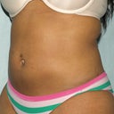 Post-Op