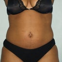 3 Months Post Op