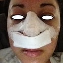 second day post op swollen slightly in my eyes..