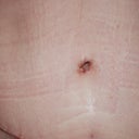 Close up of BB and incision week 2