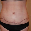 week 2 scars. Seroma causes the scar to float up on one side