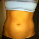 3 days after cool sculpting