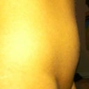 3 days after cool sculpting